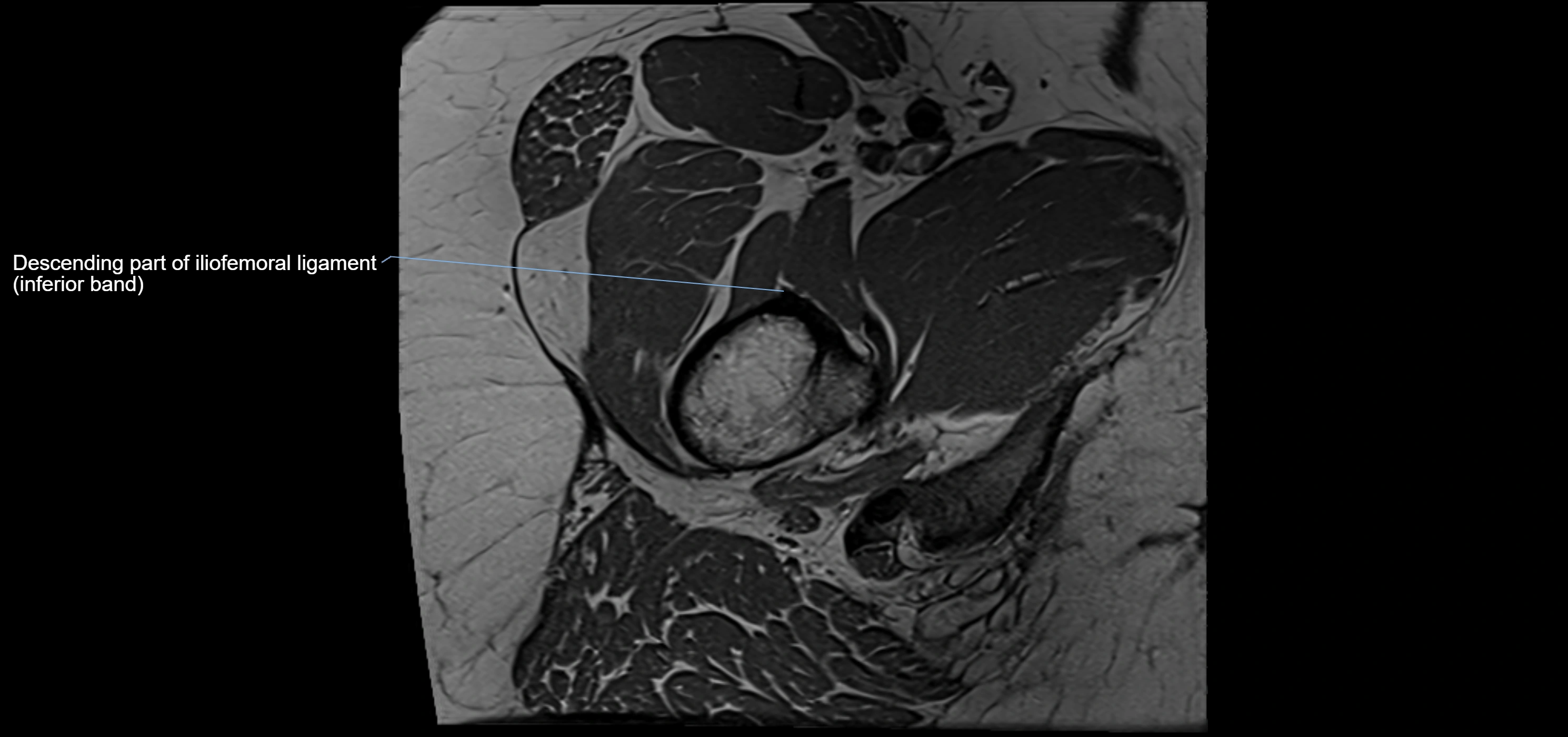 Hip ligament anatomy axial 3T MRI image -img-13001-00031.webp